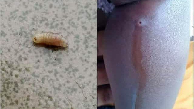 2 sinh vật lạ làm tổ trên đầu người phụ nữ - câu chuyện cảnh báo mọi người cần cẩn trọng trong những chuyến du lịch