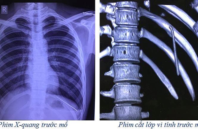 Thanh niên 18 tuổi bị đinh dài 7 cm du lịch từ vai xuống tận phổi