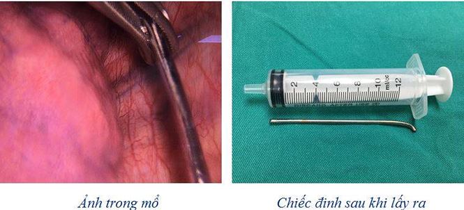 Thanh niên 18 tuổi bị đinh dài 7 cm du lịch từ vai xuống tận phổi