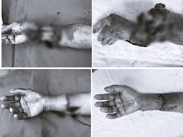 Đi gặt lúa thuê một phụ nữ bị máy tuốt lúa chém đứt rời cẳng tay