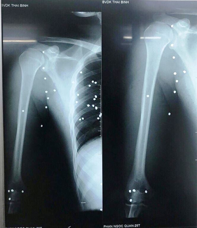 Thông tin mới vụ nổ súng hỗn chiến, 3 người trọng thương tại Thái Bình