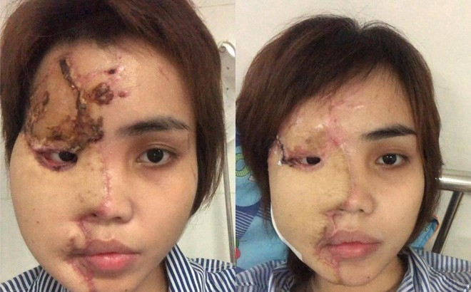 Cô gái bị thiếu uý CA tạt axit nói gì về tin bắt cá 2 tay?