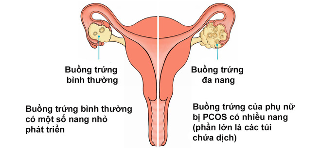 Dấu hiệu cảnh báo bạn đang bị cả hội chứng buồng trứng đa nang và lạc nội mạc tử cung khiến việc có thai càng mù mịt Dấu hiệu cảnh báo bạn đang bị cả hội chứng buồng trứng đa nang và lạc nội mạc tử cung khiến việc có thai càng mù mịt