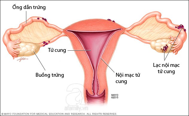 Dấu hiệu cảnh báo bạn đang bị cả hội chứng buồng trứng đa nang và lạc nội mạc tử cung khiến việc có thai càng mù mịt Dấu hiệu cảnh báo bạn đang bị cả hội chứng buồng trứng đa nang và lạc nội mạc tử cung khiến việc có thai càng mù mịt