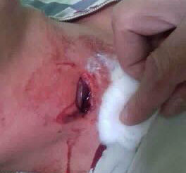 Nam thanh niên bị đạn găm trúng cổ khi đang nằm trong nhà