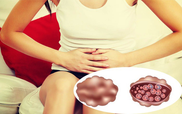 Hội chứng rối loạn tiền kinh nguyệt - căn bệnh khiến cô gái trẻ sống giữa thiên đường - địa ngục và muốn tự tử Hội chứng rối loạn tiền kinh nguyệt - căn bệnh khiến cô gái trẻ sống giữa thiên đường - địa ngục và muốn tự tử