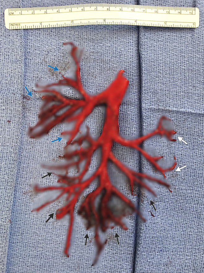 Bức ảnh người đàn ông Mỹ tử vong vì ho rơi cả phổi được lan truyền trên mạng và sự thật bất ngờ phía sau