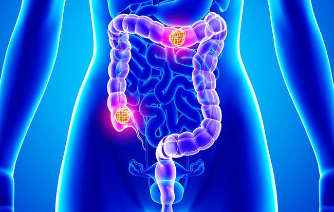 5 dấu hiệu 'rõ mồn một' cảnh báo ung thư ruột: Chớ dại bỏ qua kẻo hối hận cũng không kịp - 1 5 dấu hiệu 'rõ mồn một' cảnh báo ung thư ruột: Chớ dại bỏ qua kẻo hối hận cũng không kịp - 1