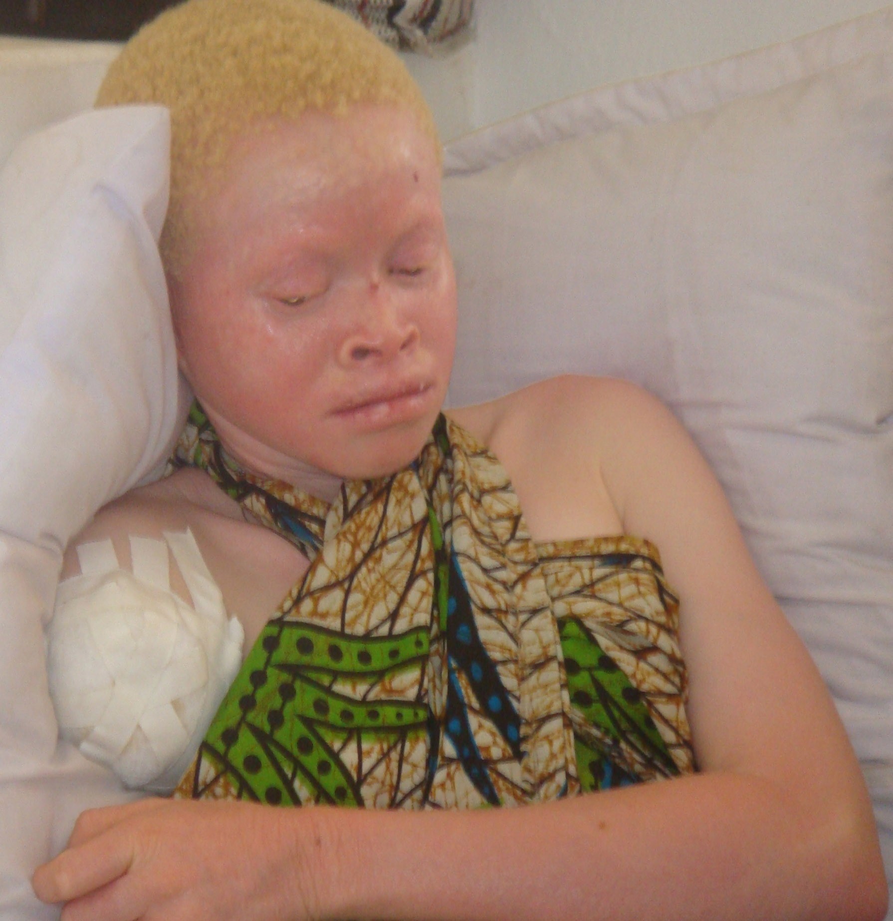 Nhiều người bạch tạng sống sót sau các cuộc tấn công nhưng không còn tay hoặc chân.