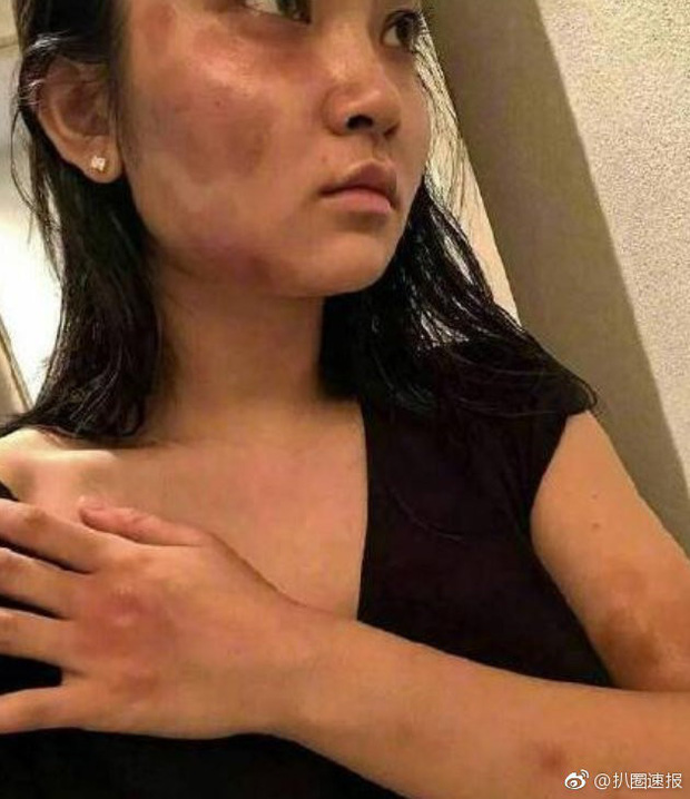 Hakura chia sẻ vết thương của mình do vụ bạo hành gây nên