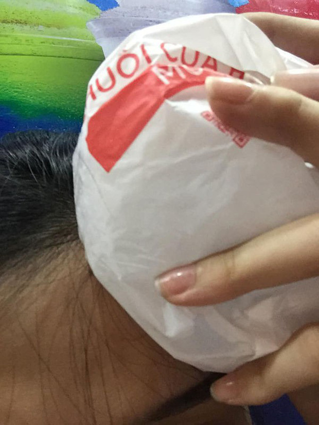 Cô gái trẻ phải chườm đá sau khi bị quạt rơi trúng.