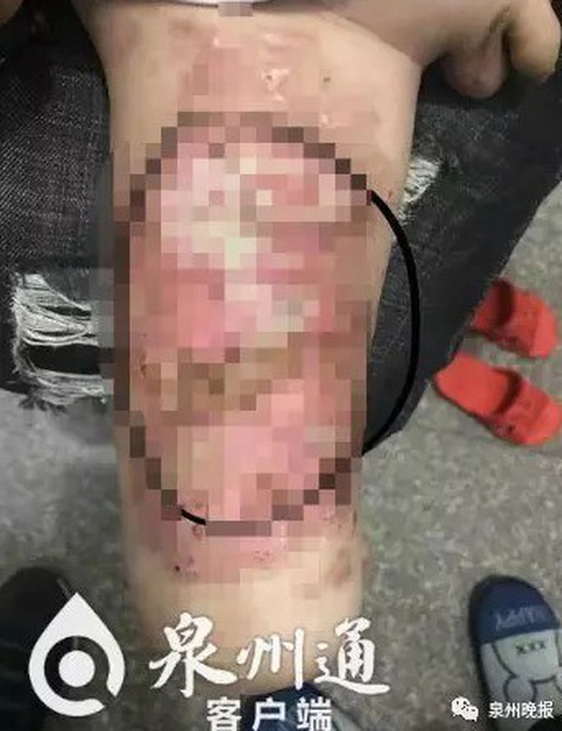 Vết bỏng trên cơ thể của Tiểu Khải.