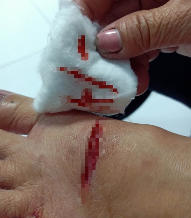 Một người bị con chó cắn bị thương