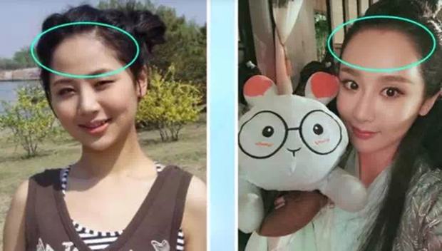 Netizen đặt nghi vấn Dương Tử phẫu thuật làm đầy vùng trán