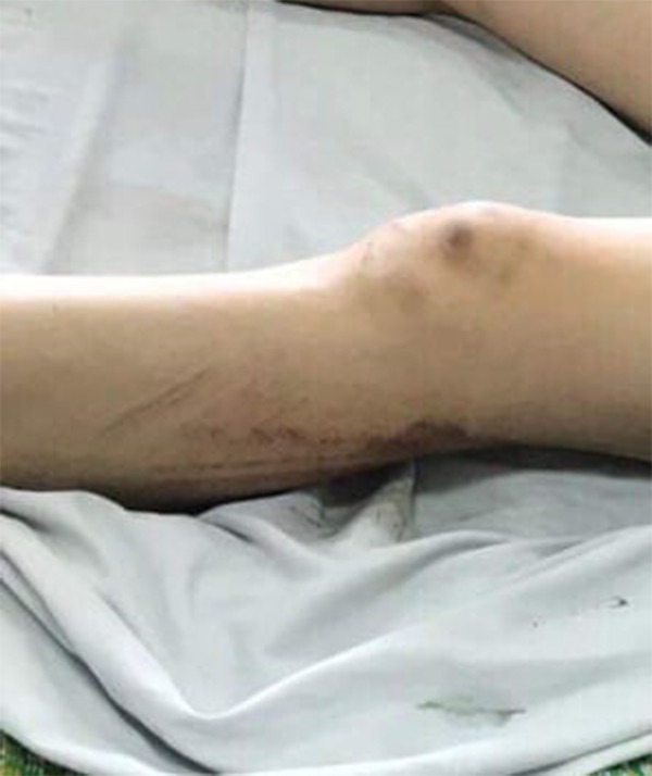 Vết thương ở chân nghi do bị ô tô ép vào tường.