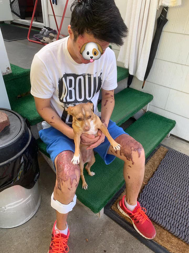 Tuy nhiên trên chân, tay và gương mặt anh Nghiêm vẫn đang phải chịu đựng những vết bỏng do axit gây ra