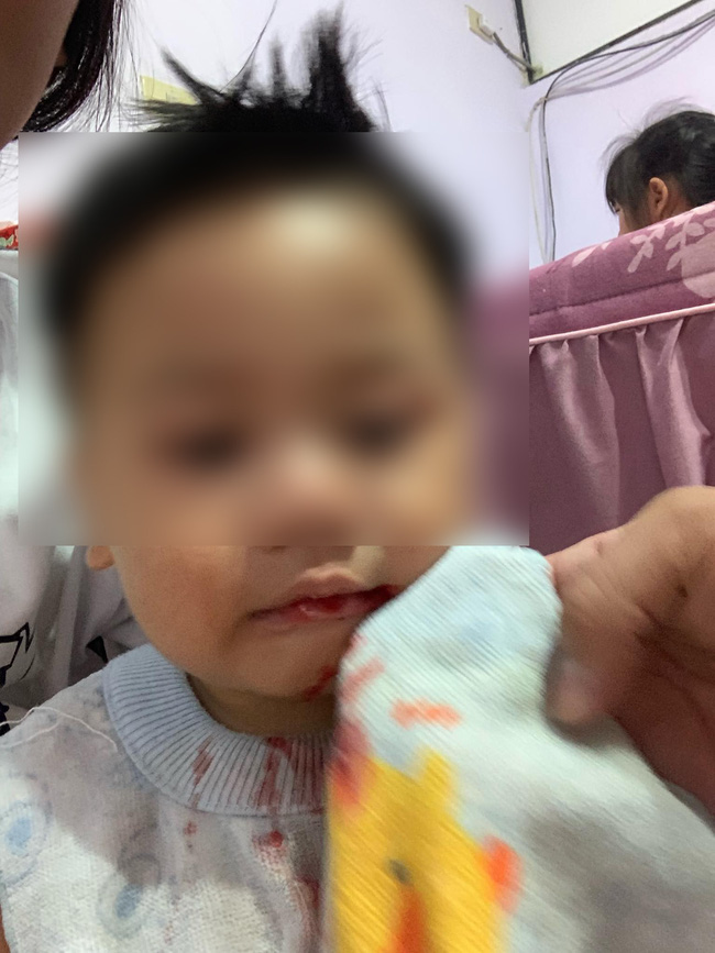 Chỉ cần lau nhẹ máu cũng chảy ra không ngừng.