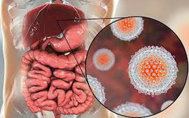 Viêm gan do virus qua đường ăn uống thường là viêm gan A.