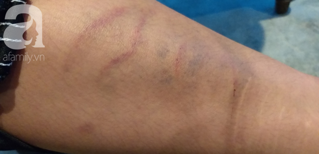 Chân trái của cháu K. vẫn chưa thể đi lại bình thường