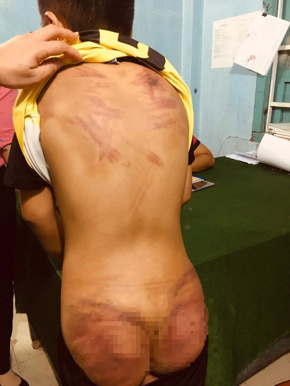 Cháu T.V.Đ.K. bị đánh đập dã man