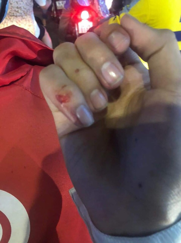 Ngón tay út bị thương được chụp lại