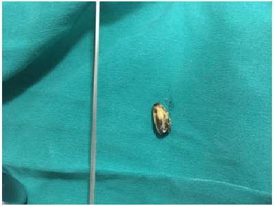 Dị vật đường hô hấp trên thường dễ chẩn đoán và điều trị còn dị vật đường hô hấp dưới thường khó chẩn đoán, điều trị khó khăn và phức tạp.