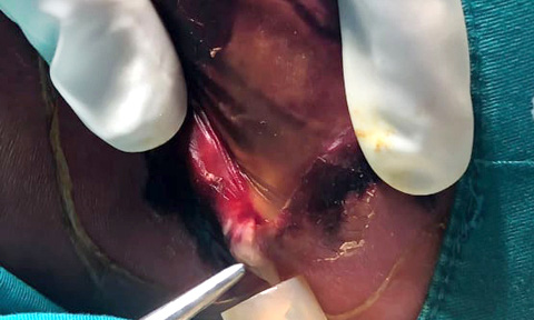 Bác sĩ tiến hành rạch dẫn lưu mủ, điều trị chỗ áp xe cho bé, đồng thời tiếp tục điều trị kháng sinh