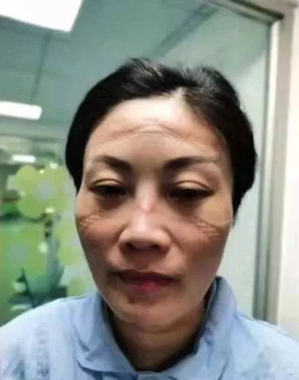 Một y tá làm việc liên tục bằng khẩu trang chuyên dụng. Vì thời gian dùng quá lâu nên chiếc khẩu trang này đã hin hằn lên gương mặt của chị.