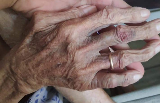 Bàn tay cụ D vẫn còn nhiều vết bầm