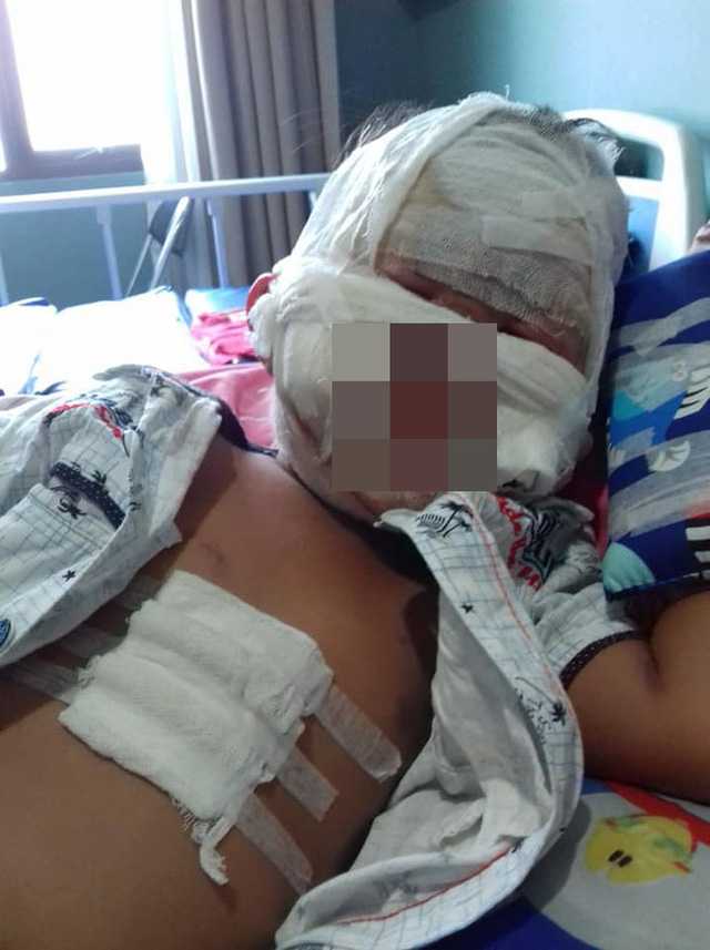 Bé gái bị bỏng nặng. Ảnh nguồn W.O.B