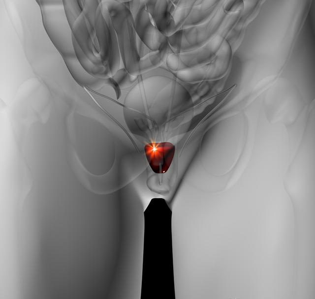 Do tăng sản tuyến tiền liệt và phì đại của tuyến, bàng quang và niệu đạo bị chèn ép, và sẽ thường xuyên đi tiểu và tiểu đêm. (Ảnh: Aboluowang)