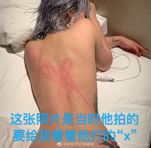 Vết thương trên lưng do dùng dây sạc quật vào người mà Khuất Sở Tiêu gây ra cho bạn gái