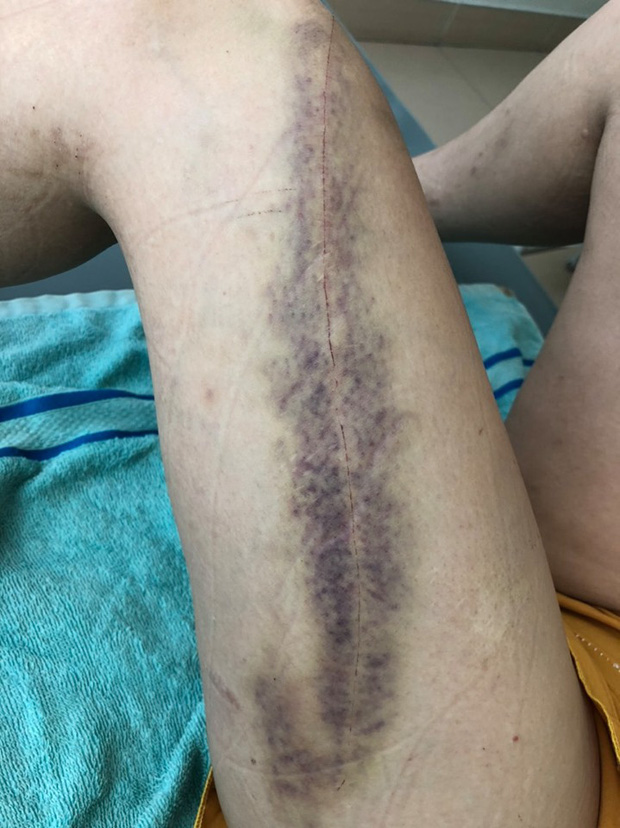 Chị Thu với nhiều thương tích được điều trị tại bệnh viện Bà Rịa.