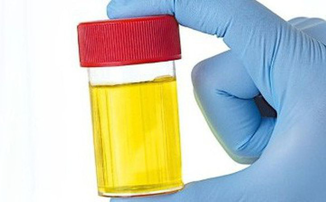 Nước tiểu thay đổi bất bình thường cũng cho thấy sức khỏe có vấn đề