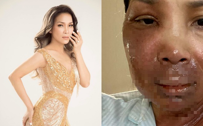 Cách đây hơn 1 tuần cô còn khiến người hâm mộ và bạn bè xót xa khi chia sẻ ảnh khuôn mặt hiện tại