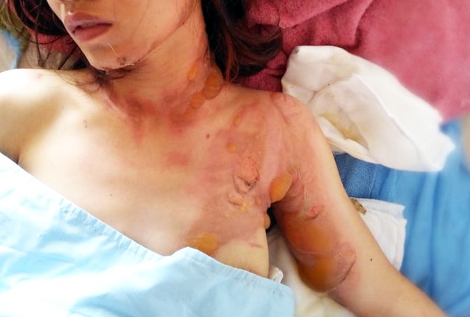 Nạn nhân bị bỏng nặng