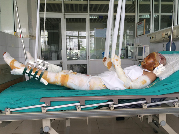 Trong 40 ngày điều trị, cô sống bằng thuốc và băng gạc. Ảnh: NVCC.