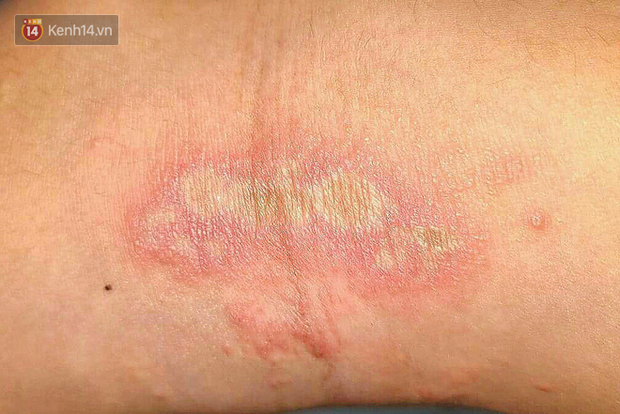 Vết bỏng do kiến ba khoang gây ra.