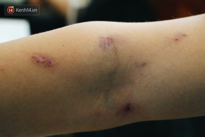Dù nghĩ ra nhiều cách diệt kiến ba khoang nhưng vẫn không thoát khỏi loại côn trùng này, vết thương chi chít trên tay của một bạn sinh viên.