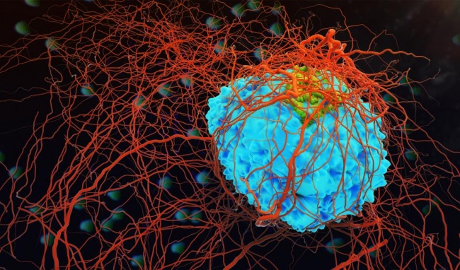 Ung thư thực sự là một căn bệnh mãn tính, giống như tiểu đường và cao huyết áp.