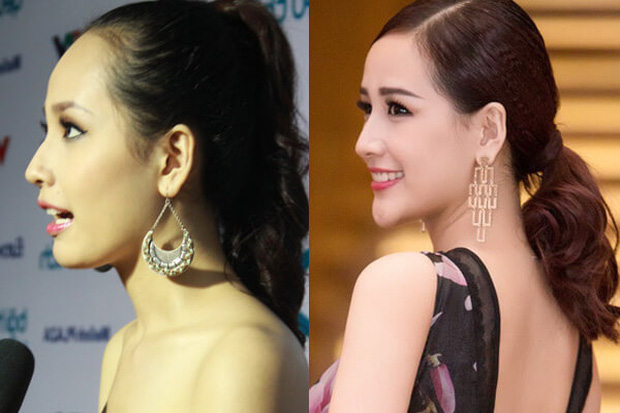 Bên cạnh đó, chiếc cằm nhọn bất thường cũng khiến nhiều người hoài nghi chuyện Mai Phương Thuý đã độn cằm.