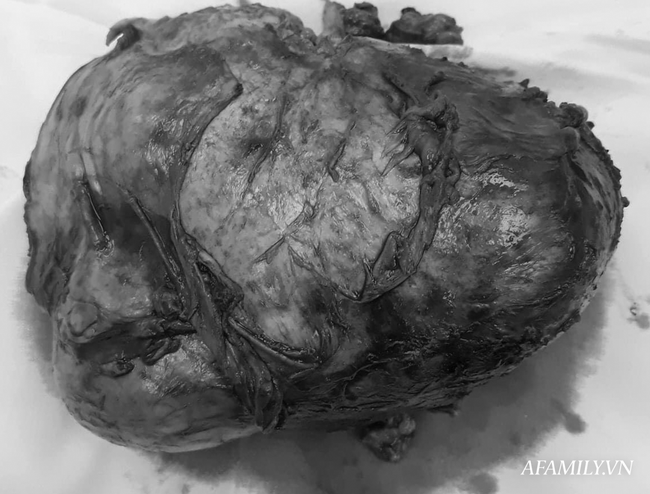 Khối u lấy ra có đường kính 20x30 cm.