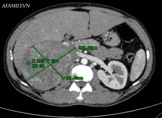 Ảnh chụp cho thấy bệnh nhân bị tổn thương vùng giữa gan và thận phải kích thước lớn.