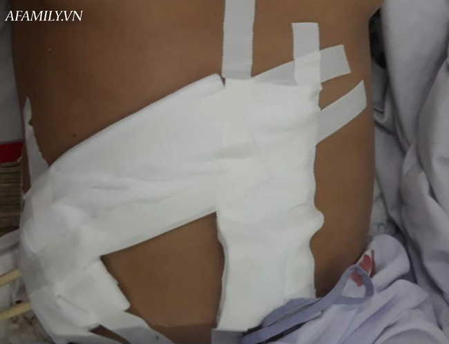 Bệnh nhân có tiền sử cao huyết áp và bị nữ hóa tuyến vú.