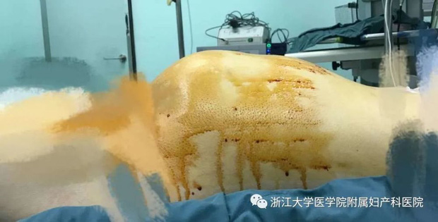 Phần bụng phình to của Xiaojia hóa ra là một khối u buồng trứng khổng lồ, có cân nặng lên tới 9kg.