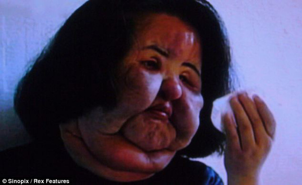 Gương mặt phù nề khiến bà đau khổ vì bị người thân không nhận ra