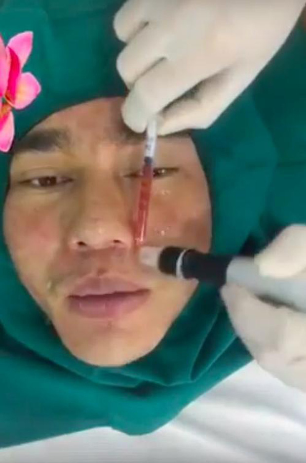 Câu chuyện phẫu thuật thẩm mỹ của Lê Dương Bảo Lâm khiến nhiều khán giả không khỏi rùng mình