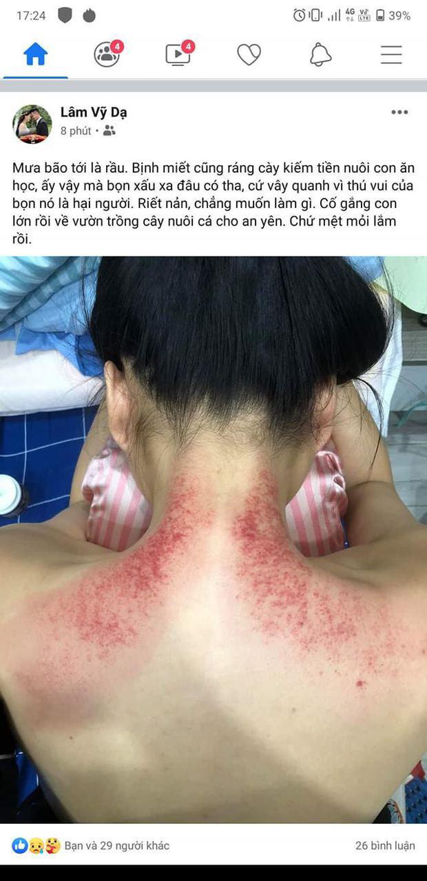 Hình ảnh lưng trần rướm máu vì cạo gió của Lâm Vỹ Dạ trước đó