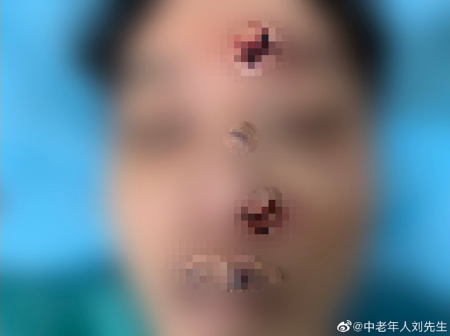 3 vết thương bất thường trên mặt người chết.