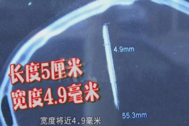 Kích thước mũi kim trong đầu cô Chu.